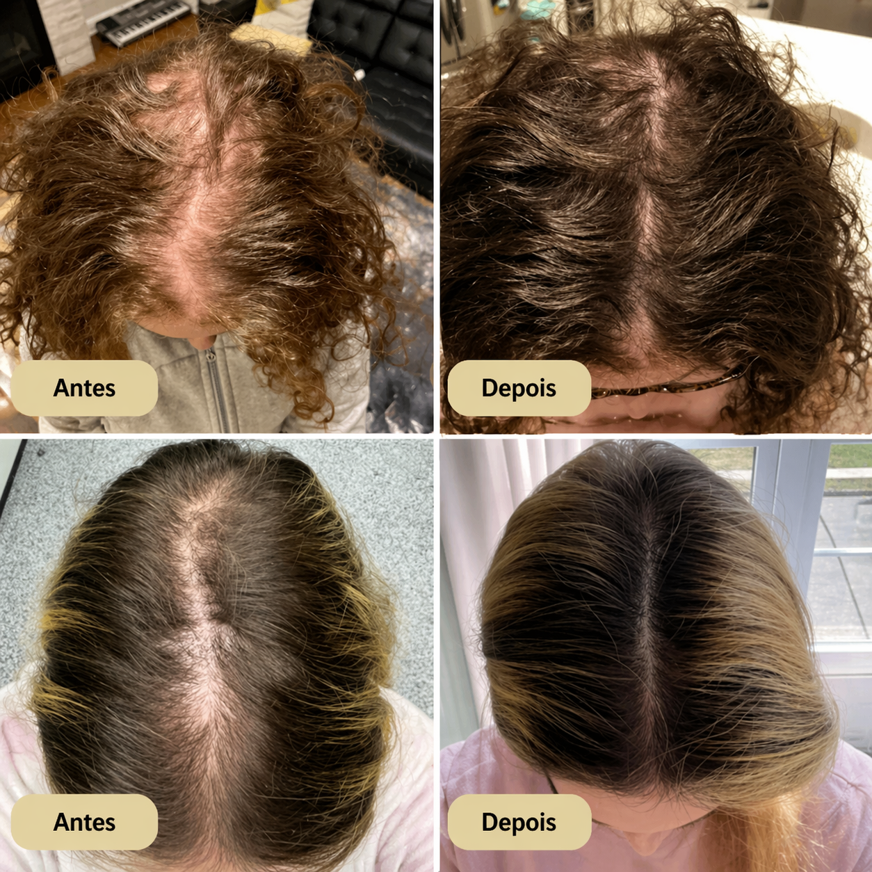 Tratamento com óleo natural para o crescimento do cabelo (Edição limitada)
