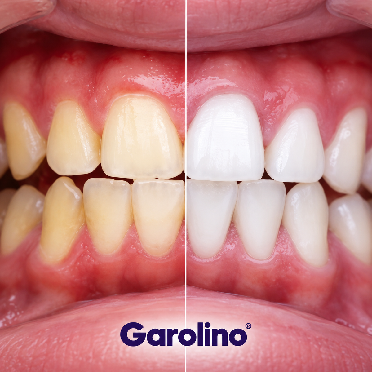 Branqueador dental V34 (Edição limitada)